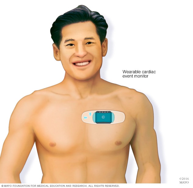 Cardiac Event Monitor - Mayo Clinic