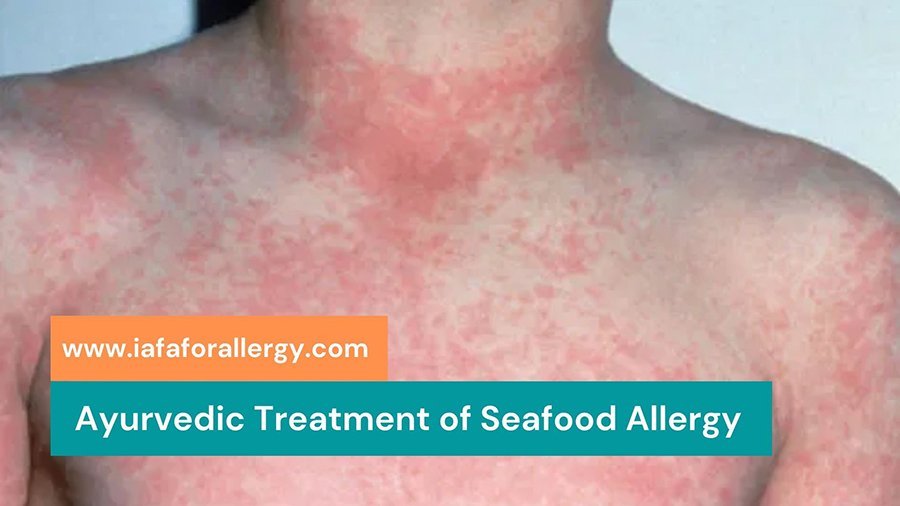 Seafood Allergy - Causes, Symptoms And Ayurvedic Treatment